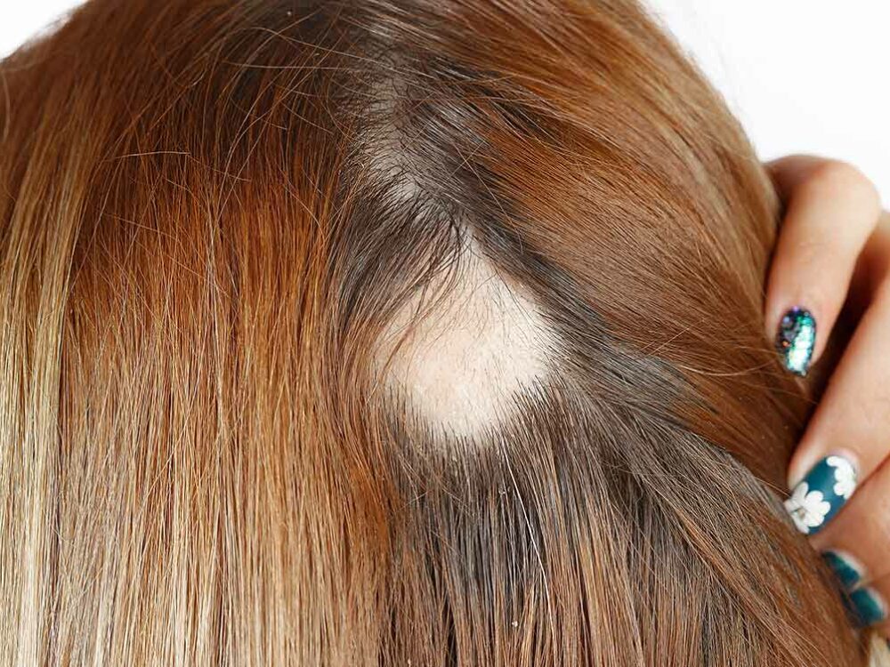 Haarausfall auf dem Kopf einer Frau