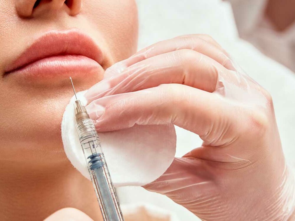 Unterspritzung der Lippen mit Hyaluronsäure