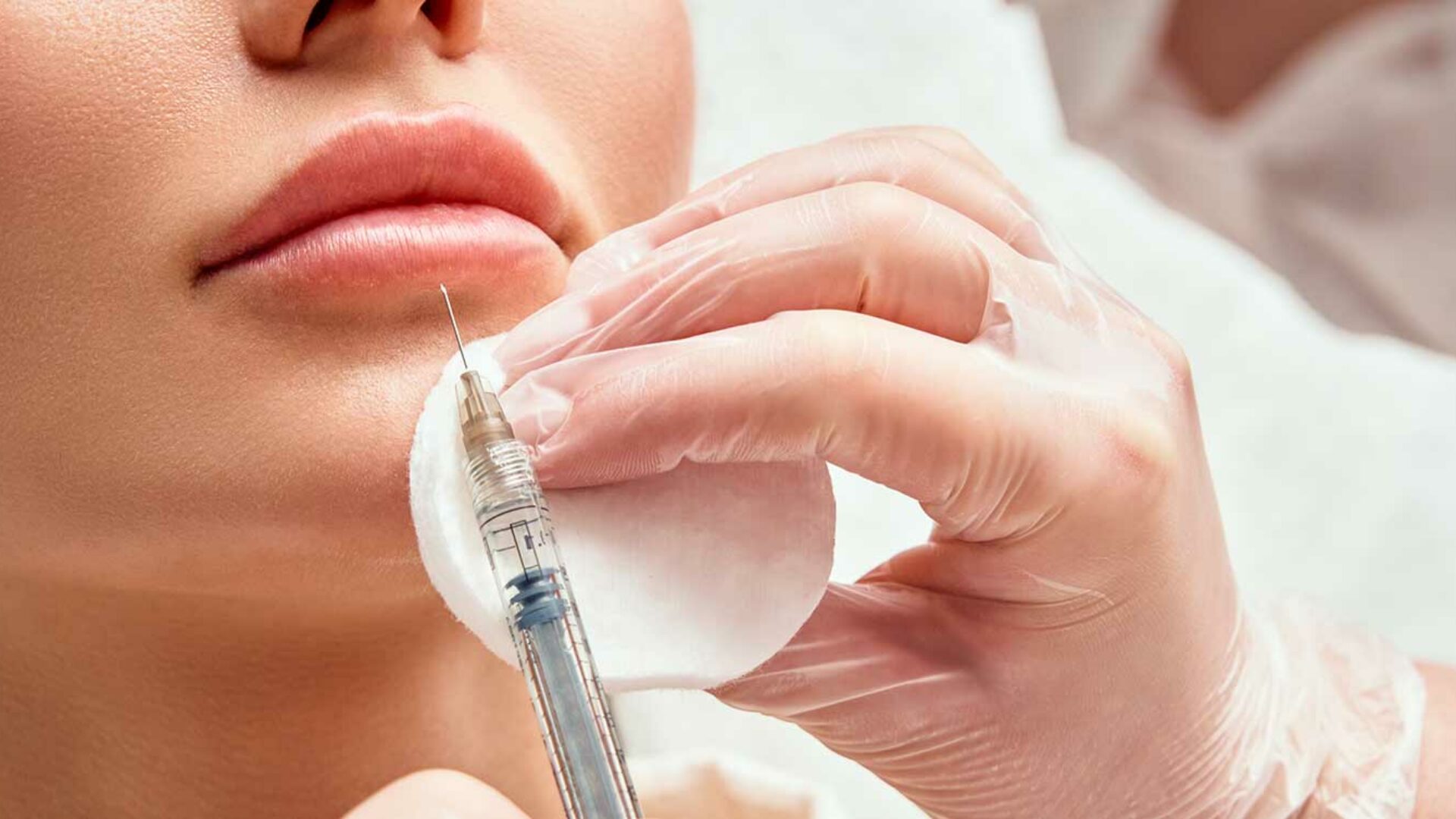 Unterspritzung der Lippen mit Hyaluronsäure