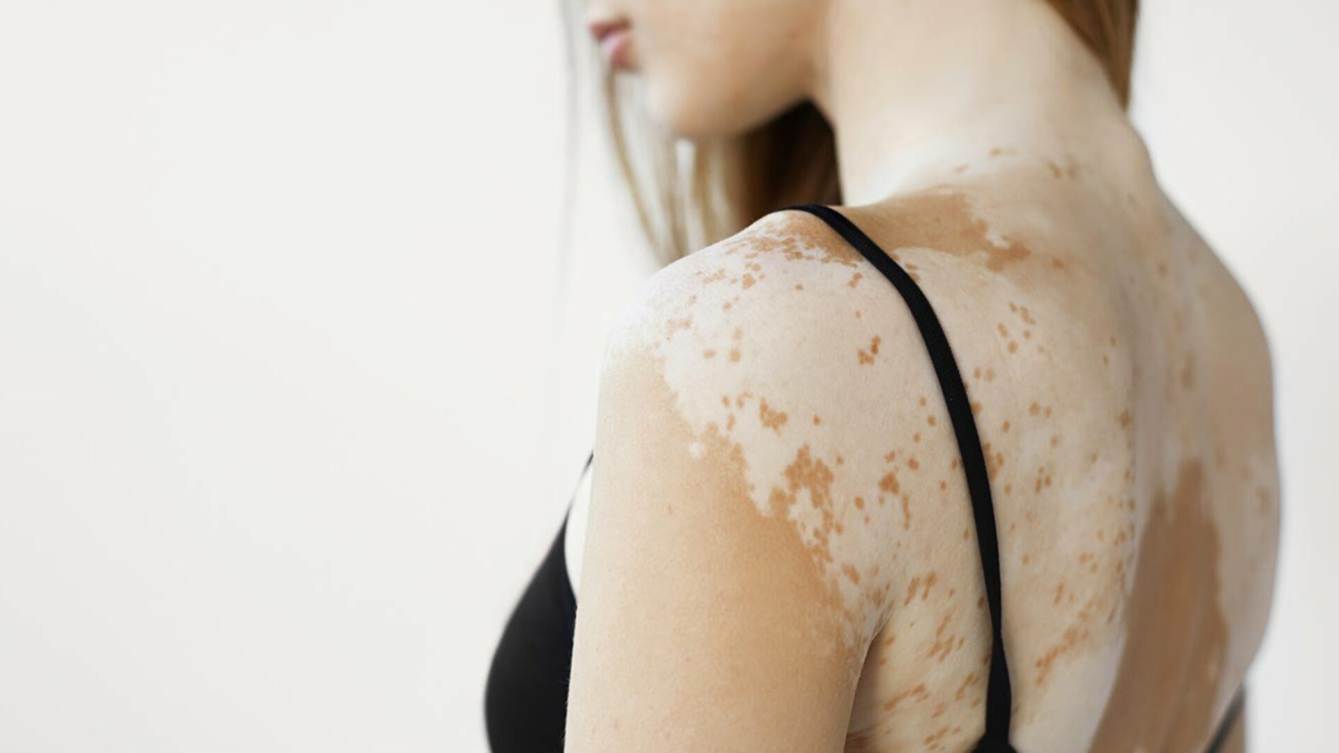 Vitiligo (Weißfleckenkrankheit) behandeln lassen